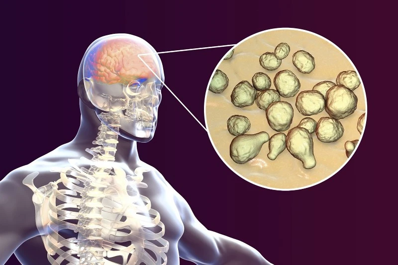 cryptococcalmeningitisg961551488523 cryptococcalmeningitisg961551488523