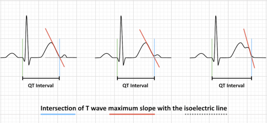 QT interval