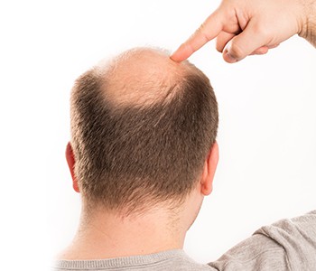 Les personnes souffrant de perte de cheveux sont ravies ! Ce produit peut rée...