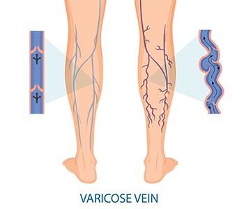 Quand faut-il intervenir en cas de varices ? Le meilleur choix pour éviter le...